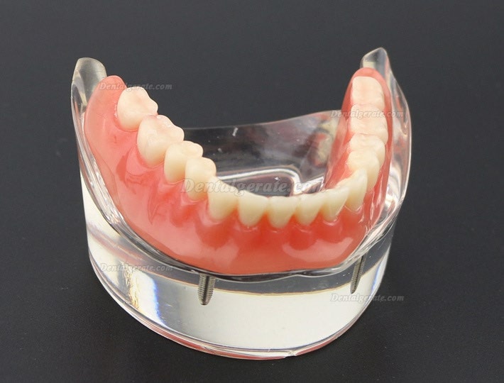 Modell f&uuml;r zahn&auml;rztliche Oberz&auml;hne Overdenture Superior 4 Implantate Demo Modell 6001 02